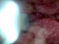 Endoscope Camera Shows Sensitive Penis Parts in Educational Video